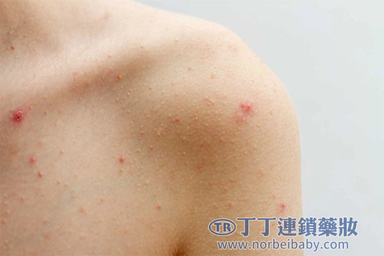 過敏反應(皮疹、呼吸困難) 過敏反應(皮疹、呼吸困難)