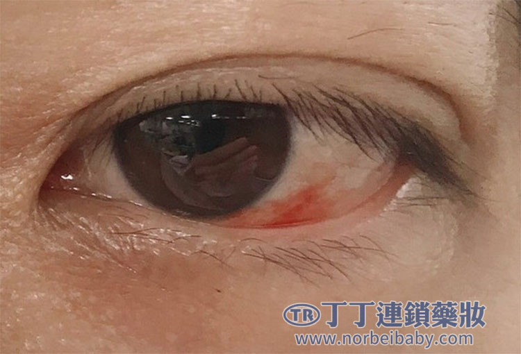 視覺異常 視覺異常
